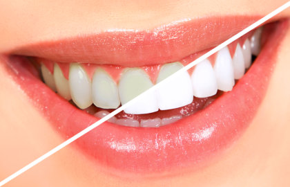 Smile Clinic-Allen Park, MI - GLO Teeth Whitening